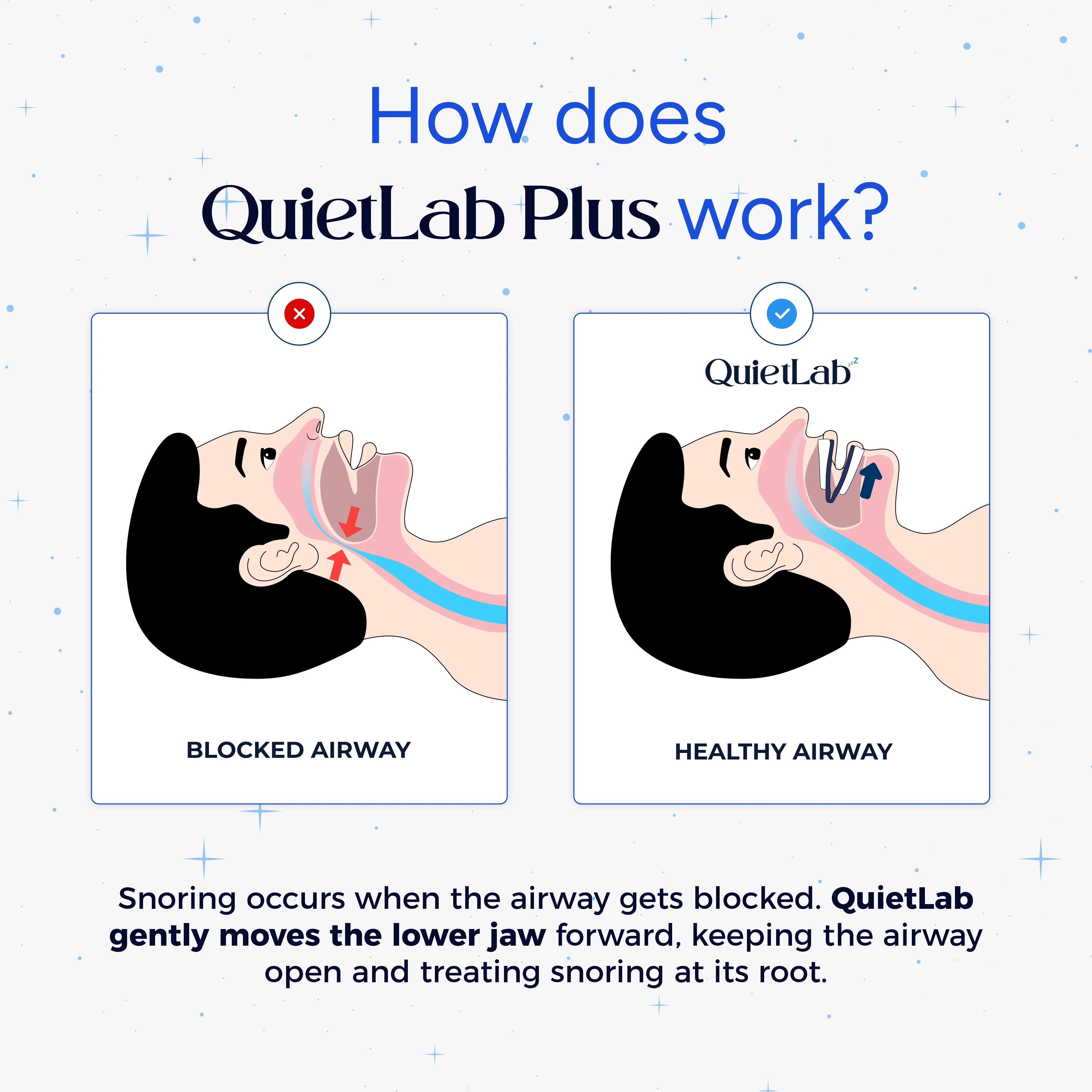QuietLab Plus® Anti-Snoring Mouthpiece - Image 5