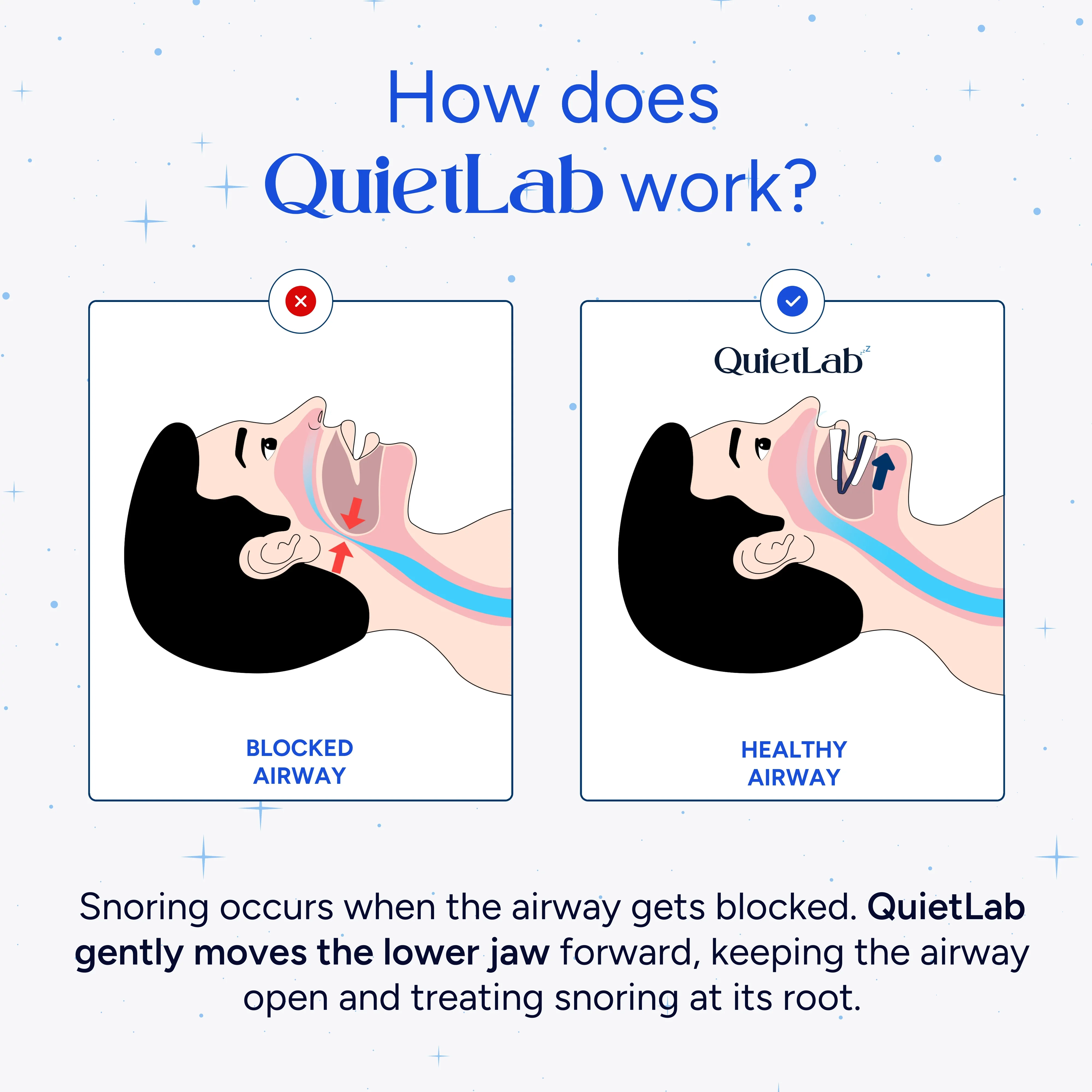 QuietLab Pro® Anti-Snoring Mouthpiece - Image 4